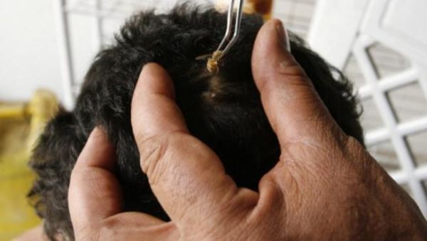 فلسطيني يعالج بواسطة النحل في احدى العيادات الطبية بغزة/الصور لـ أ.ف.ب