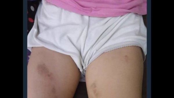 طفلة حايل المعنفة