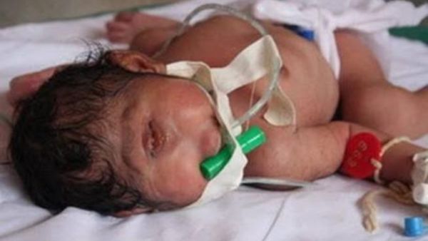 أجهزة الطفل تعمل بشكل طبيعي رغم التشوه