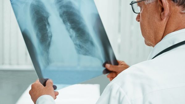 A chest x-ray is one of the best tests for diagnosing pneumonia, HMC experts say. A chest x-ray is one of the best tests for diagnosing pneumonia, HMC experts say.