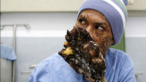 الرجل الشجرة اثناء العلاج