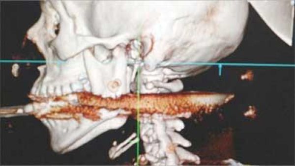صورة باشعة اكس تظهر الرمج في العنق