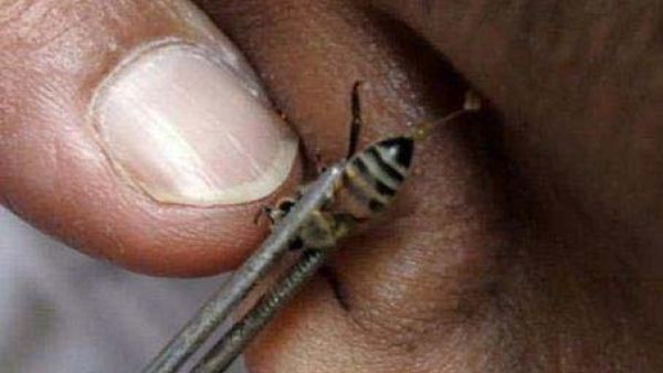 اللسع بالنحل