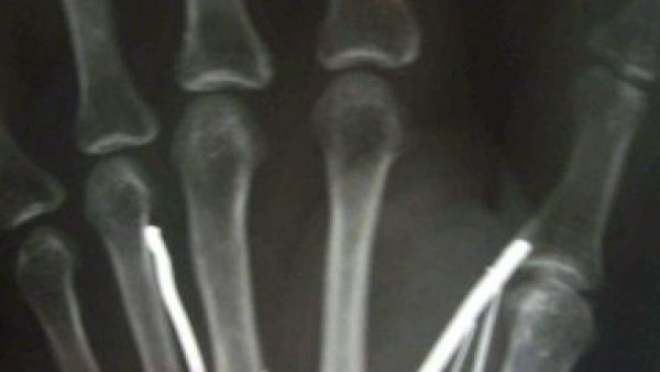 صورة اشعة ليد الخادمة السريلانكية تظهر وجود مسامير
