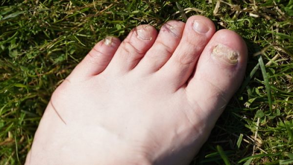 الصدمة – قد ينتج انغراز الظفر في اللحم 