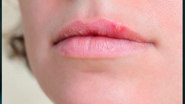 تظهر قرح الفم عادة بسبب الإجهاد أو الحالة النفسية للفرد