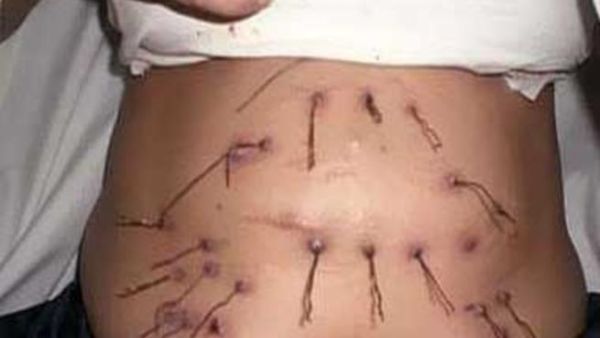 بطن الاندونيسية