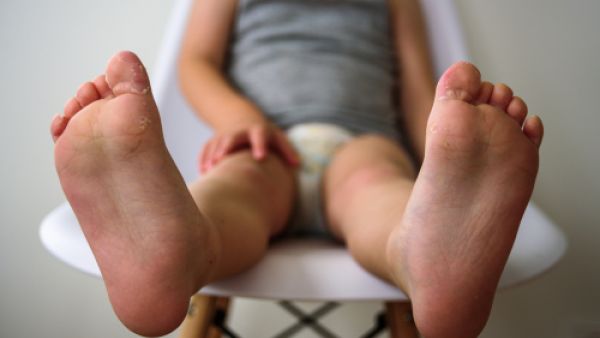 هناك بعض العلاجات التي تستخدم في تقليل حدة مرض الصدفية (shutterstock.com)
