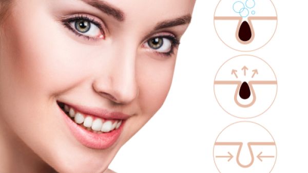 تتشكل الرؤوس السوداء عند انسداد مسام الجلد بالزيوت والأوساخ (shutterstock.com)
