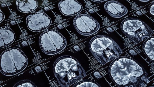 يدرك العلماء  أن قنوات صرف السوائل الخاصة بالدماغ تكون من خلال الجهاز اللمفاوي