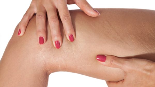 علامات التمدد هي شكل من أشكال الندب غير المؤذية على الجلد (shutterstock.com)
 علامات التمدد هي شكل من أشكال الندب غير المؤذية على الجلد (shutterstock.com)