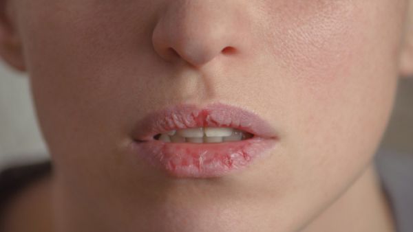 استخدمي بلسم للشفاه الذي يعالج الشفاه (shutterstock.com)