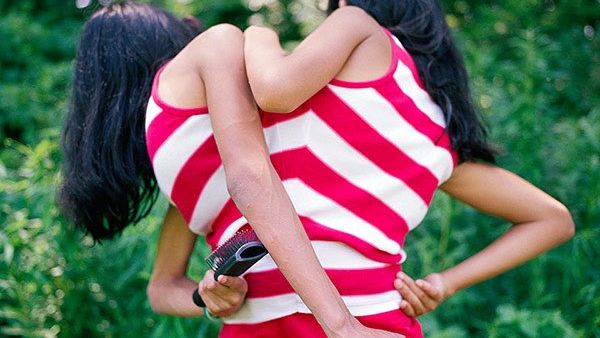 التوأم المكسيكي المتصل "كارمن ولوبيتا" 