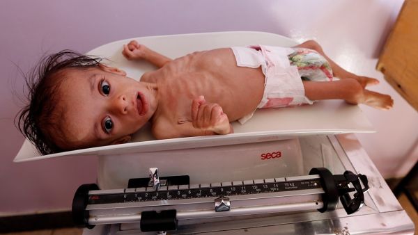A malnourished child receives treatment at a hospital in the Yemeni capital, (Sana'a Mohammed Huwais/AFP)