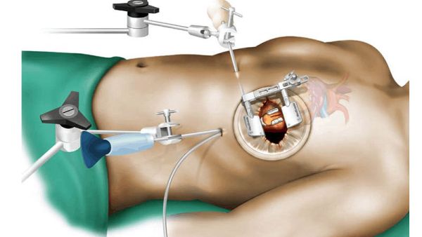 كم يعيش الانسان بعد عملية القلب المفتوح