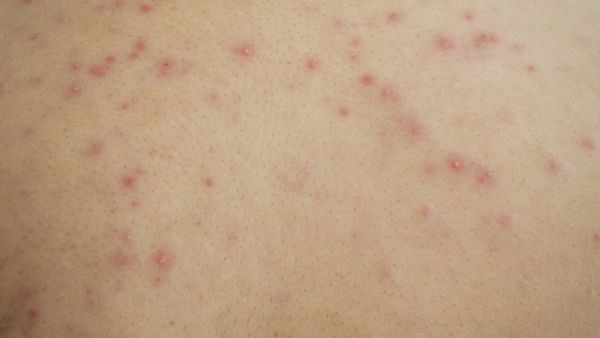 من أسباب الإصابة بحمو النيل ارتفاع درجة الحرارة وعدم وجود تهوية جيدة