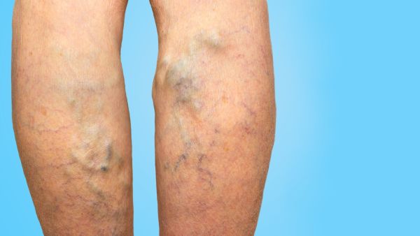 استخدام الجوارب الضاغطة من أفضل الحلول المعترف بها لعلاج الدوالي