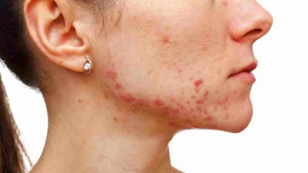بكتيريا الوجه يظهر في شكل طفح جلدي أحمر