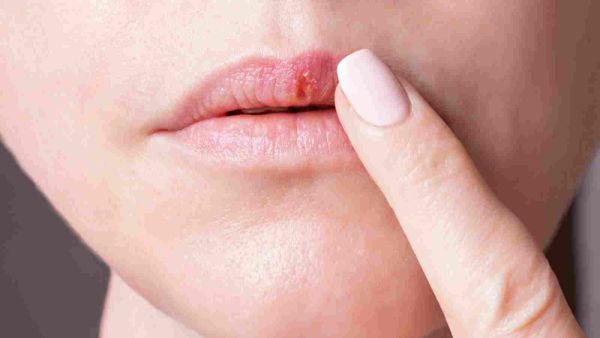 استخدام مرطب الشفاه يساعدك في التخلص من تشقق الشفاه والتنميل المرافق له