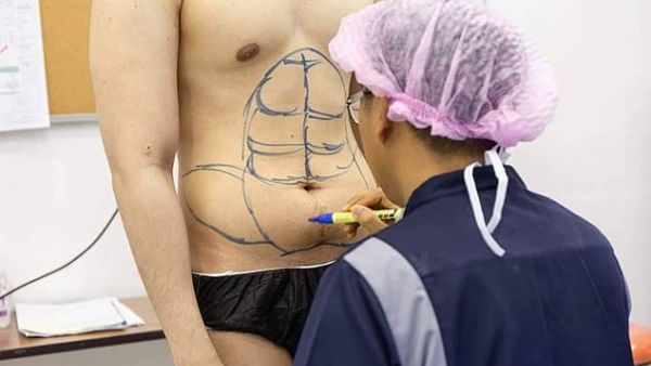 A photo ahead of the operation a photo shows the surgeon marking out individual abdomen muscles on his flat stomach. (Daily Mail)