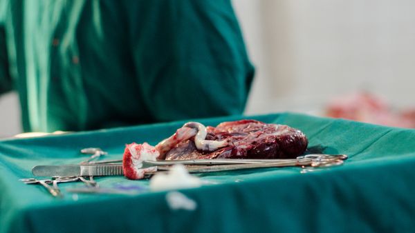 Freshly removed placenta after C-section in Indian hospital. (Shutterstock/ File Photo)
