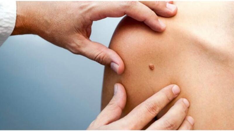 5 طرق فعالة للتخلص من الثآليل طبيعيا البوابة