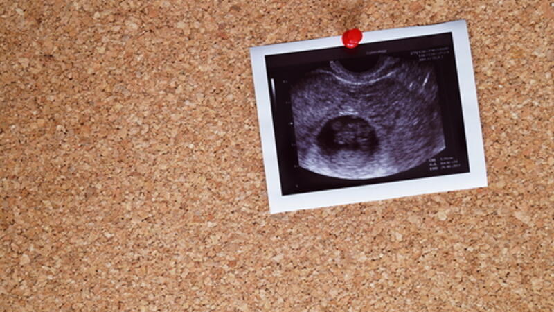 في أي شهر يمكن معرفة نوع الجنين بالسونار البوابة