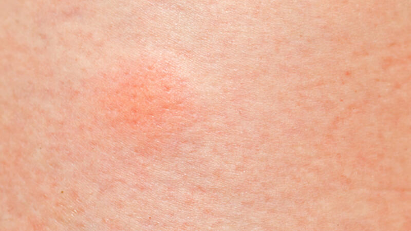 ظهور بقع حمراء في الجسم مع الحكة الأسباب طرق طبيعية للعلاج البوابة