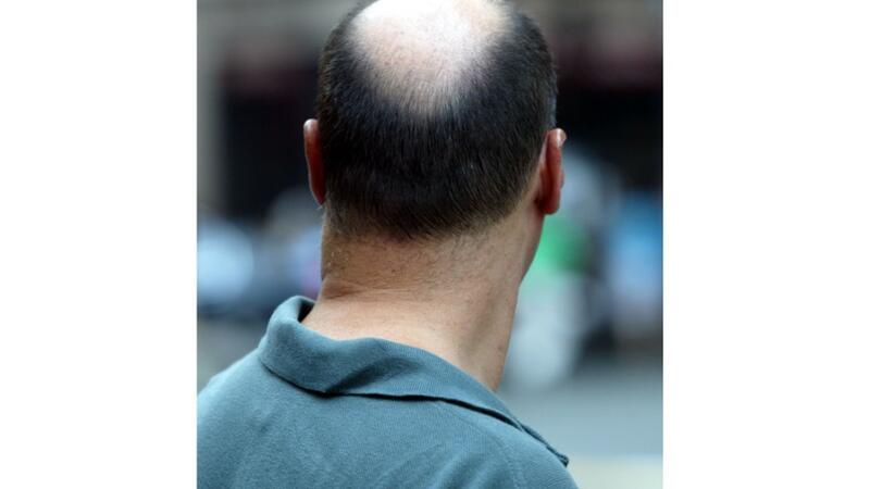 Attention Bald Men Your Own Skin May Start Regrowing Hair Al Bawaba