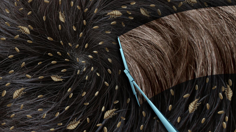 تفسير حلم القمل في الشعر وقتله البوابة