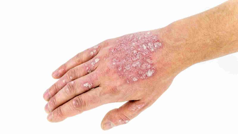 الصدفية أنواعها أعراضها وأسبابها طرق علاجها البوابة