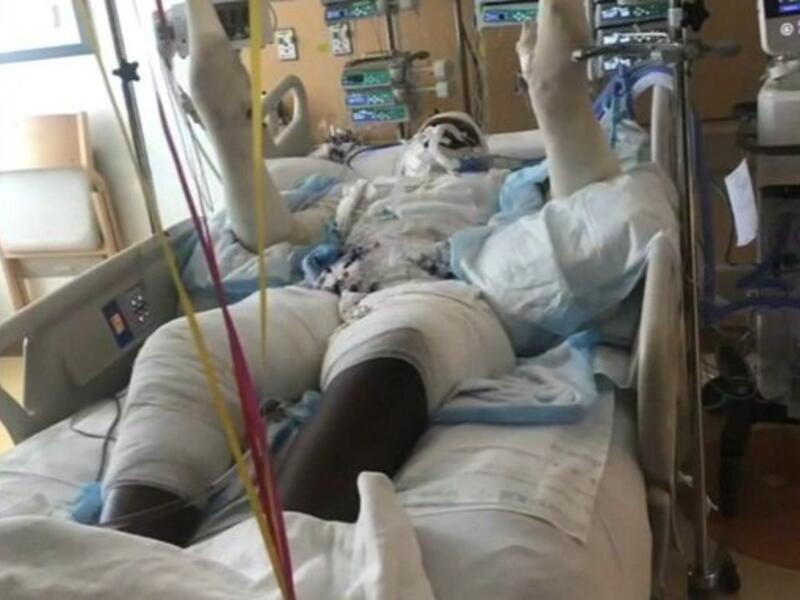 Burned teen warns against YouTube fire challenge. (Twitter)