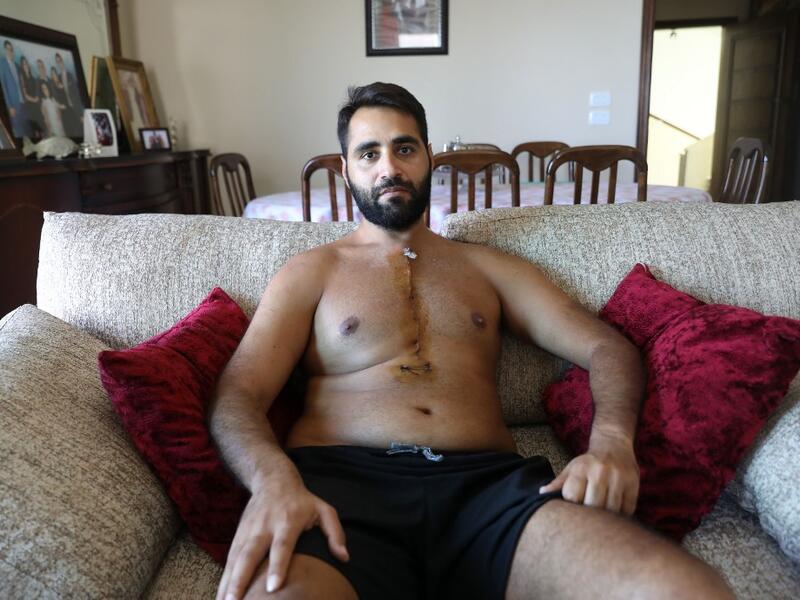 Firas Hamdan, a 33-year-old Lebanese lawyer, displays his scar. ANWAR AMRO / AFP