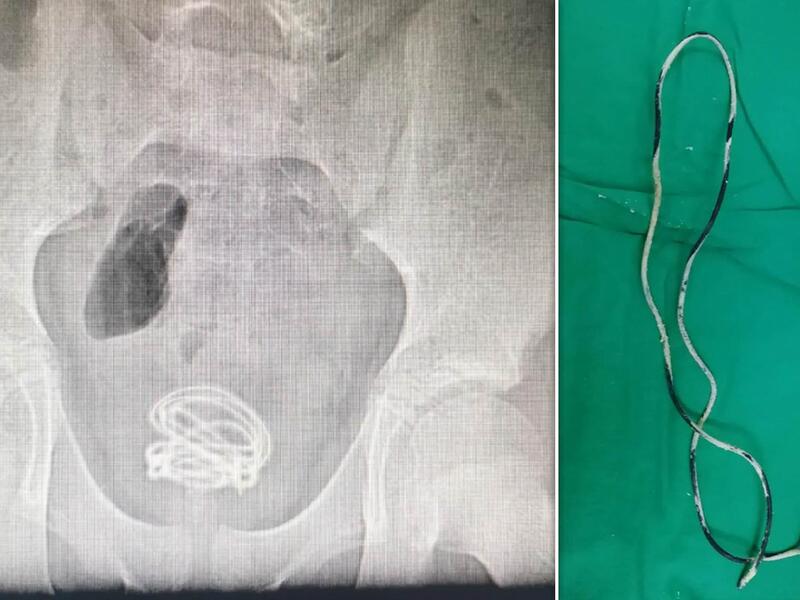 سلك كهربائي بطول 60 سم يستقر في مثانة طفل صيني
