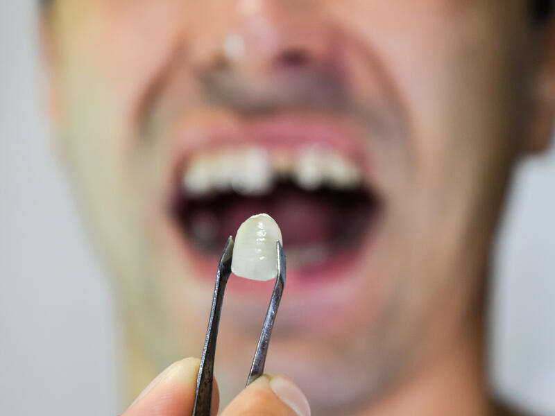 Man files a lawsuit after he slipped and broke his teeth