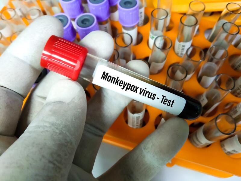 WHO says it's 'not concerned' about monkeypox outbreak turning into pandemic