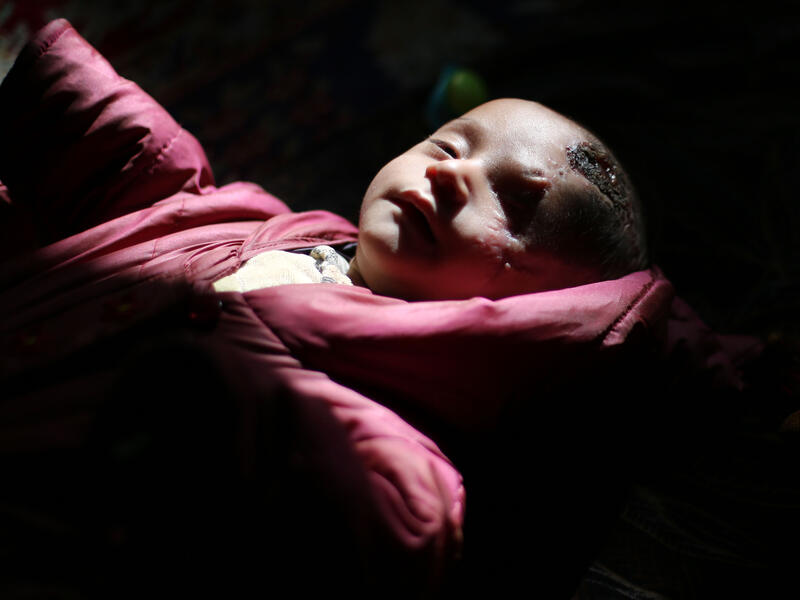 Blinded and seriously injured, baby Karim Abdallah becomes a symbol of Eastern Ghouta Siege /AFP