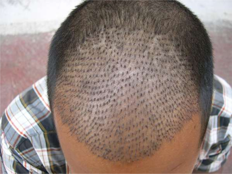 hair implants