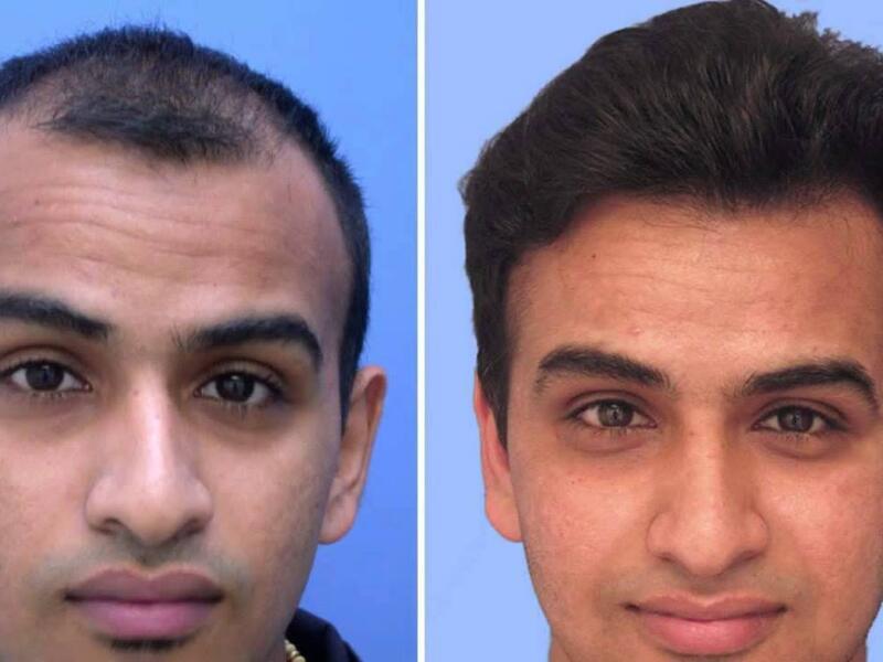 Middle Eastern Men Are The World S Biggest Losers Of Hair Al