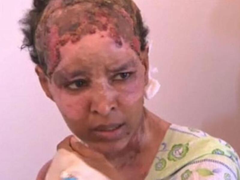 
مربية أبناء هانبيبال القذافي الإثيوبية "شويقة" وقد تعرضت لحروق شديدة تسببت بها زوجة هانيبال ألين سكاف اللبنانية حين قامت بصب الماء المغلي على جسمها عندما فشلت الخادمة في إسكات ابنة هانيبال الصغيرة.
