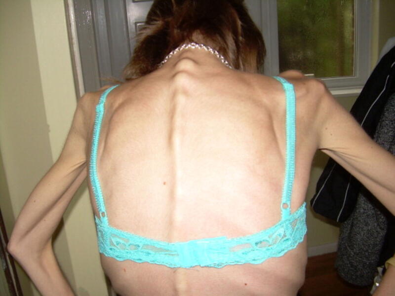 Hot? NOT! Anorexia is growing throughout the world and the Middle East is no exception. 