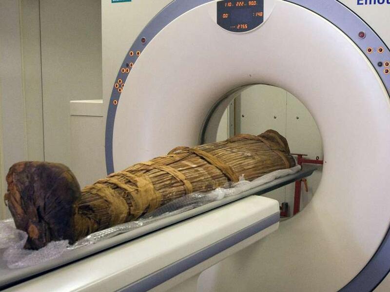 Researchers have found that long before the Western diet of red meat, fat and salt, ancient hunter-gatherers also suffered from clogged arteries.
