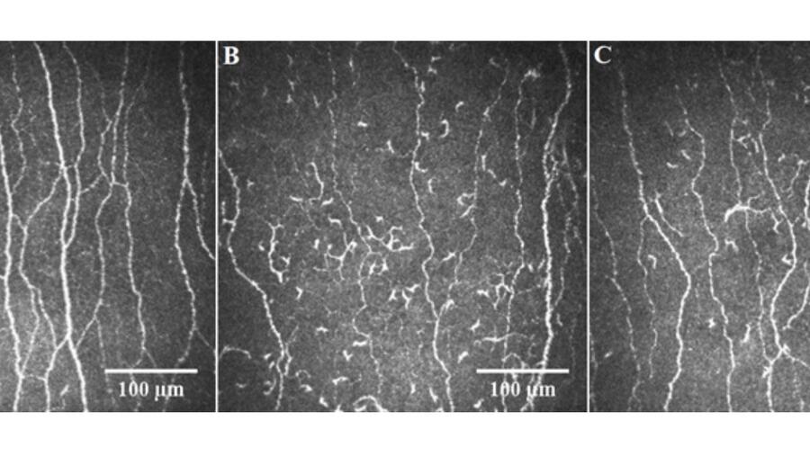 باحثو وايل كورنيل للطب قطر يستخدمون فحص مجهر القرنية المتّحد البؤر لتحديد تلف الأعصاب في حالات الكوفيد الطويل الأمد