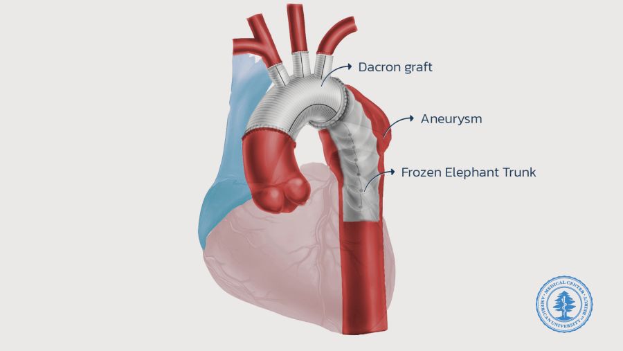 إنجاز في جراحة القلب: المركز الطبي في الجامعة الأميركية في بيروت يجري أول جراحة "Frozen Elephant Trunk" في لبنان بنجاح 