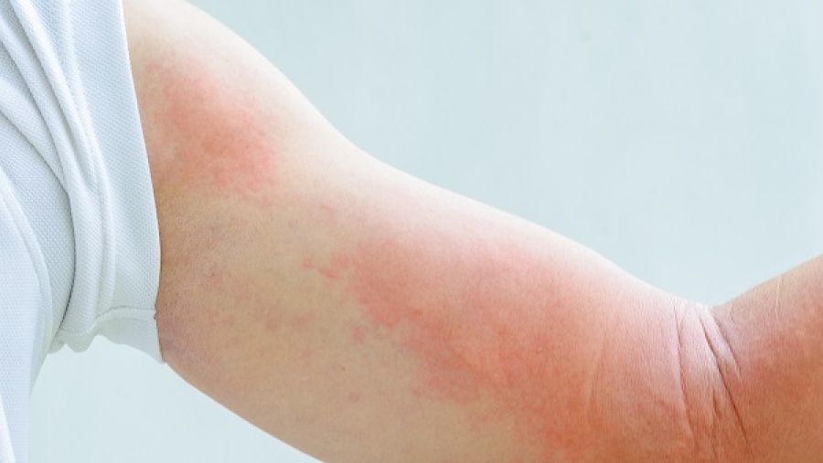 قد تتضمن أعراض ردة الفعل التحسسية للسعات الحشرات الطفح الجلدي والتورم