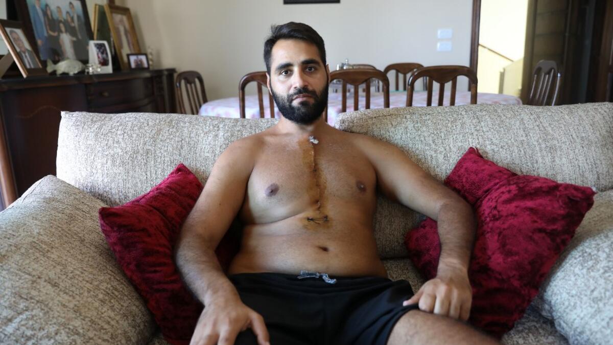 Firas Hamdan, a 33-year-old Lebanese lawyer, displays his scar. ANWAR AMRO / AFP