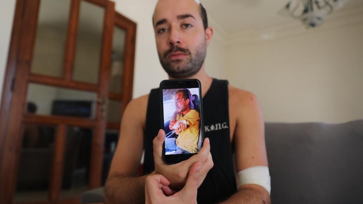 Lebanese makeup artist Sharbel Hasbany, 29, who was injured in the massive Beirut port explosion, displays an image on his phone of himself after the blast, during an interview at home in the Sin el-Fil neighbourhood of the Lebanese capital, on August 16, 2020. ANWAR AMRO / AFP