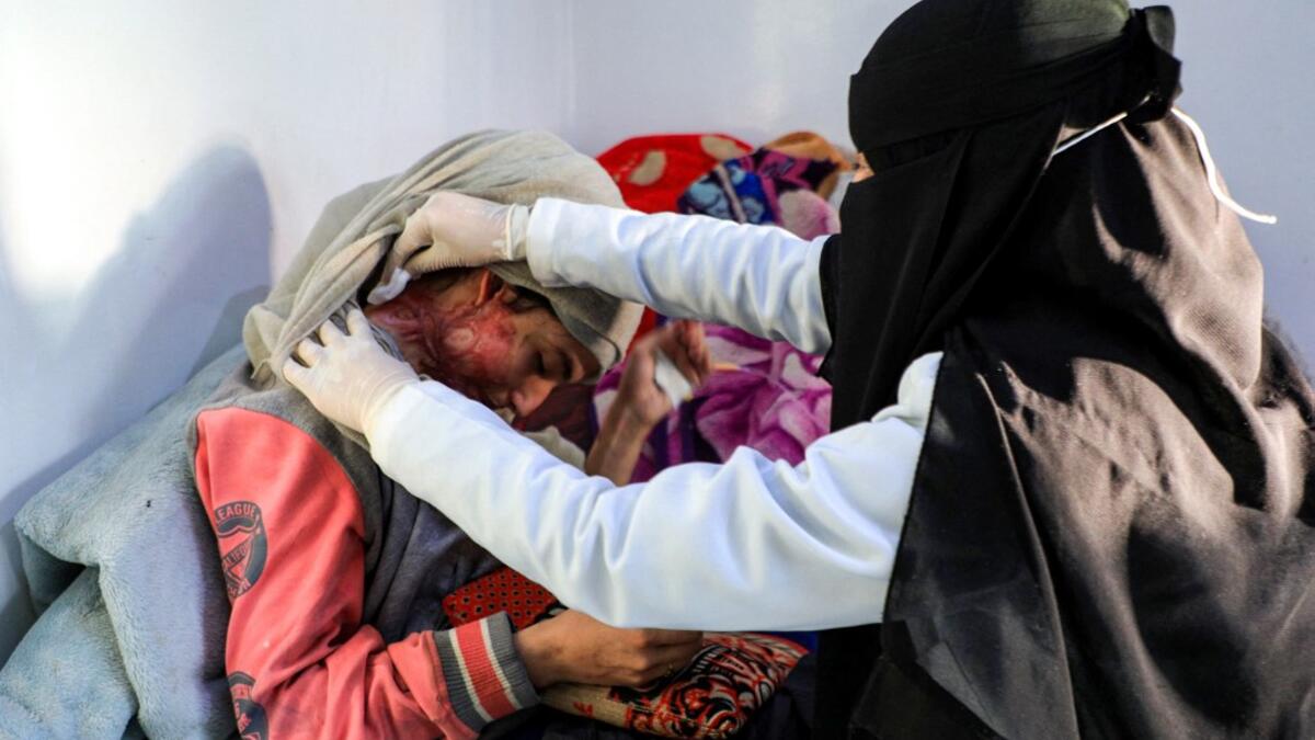 Al-Anoud Hussain Sheryan, a 19-year-old girl disfigured in an acid attack by her abusive husband, sits at a hospital where she is undergoing treatment in Yemen's capital Sanaa on January 28, 2021 as a woman unwraps her veil to show her injuries. Married at the age of 12, rejected at 16, and then disfigured in an acid attack, Sheryan's fate is a shocking illustration of abuse in a society beset by war and poverty. Now aged 19, the young Yemeni woman agreed to relate her ordeal at the hands of her abusive hus