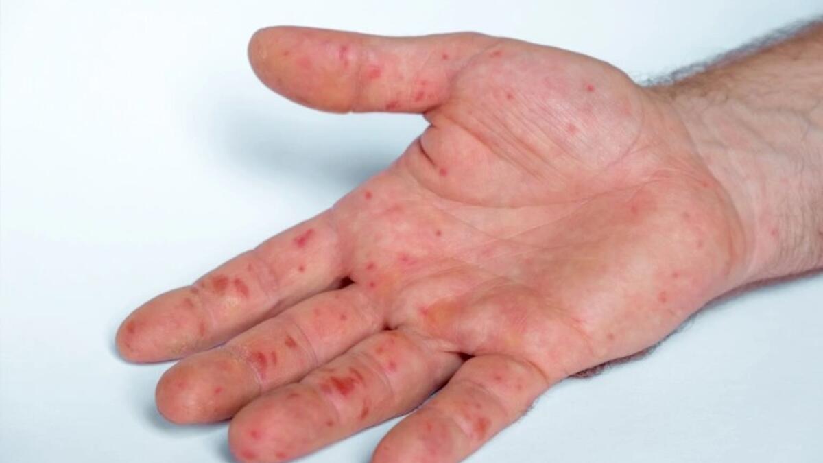 حصلت إنفلونزا الطماطم على اسمها، من حقيقة أن البثور غالبًا ما تكون كروية اللون وحمراء اللون.