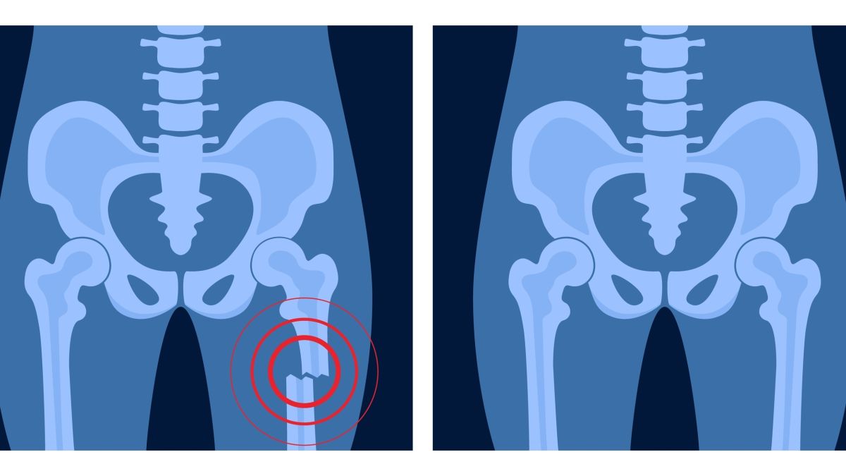 bone glue